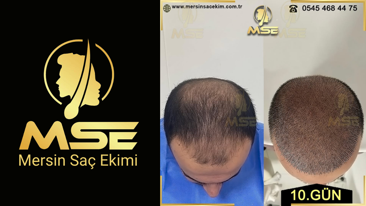 MERSİN SAÇ EKİMİ